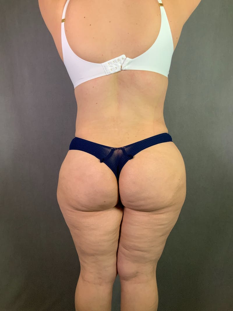 Liposuction Before & After Gallery - Patient 167391182 - Image 16