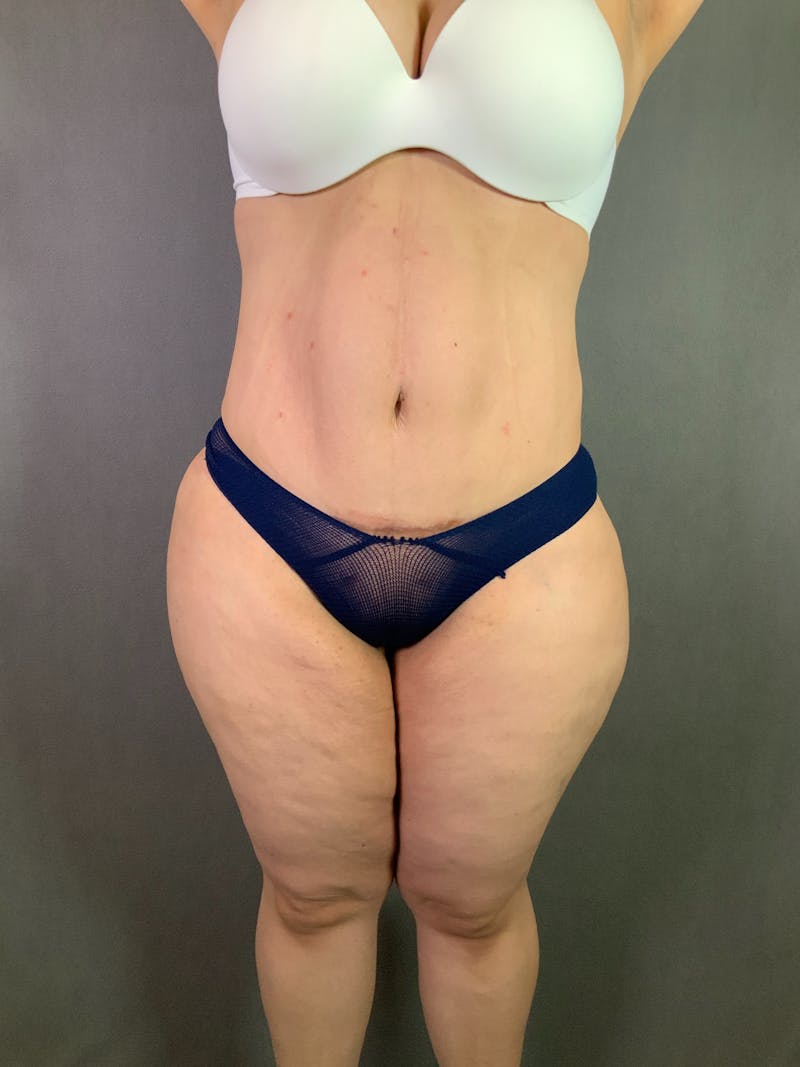 Liposuction Before & After Gallery - Patient 167391182 - Image 2