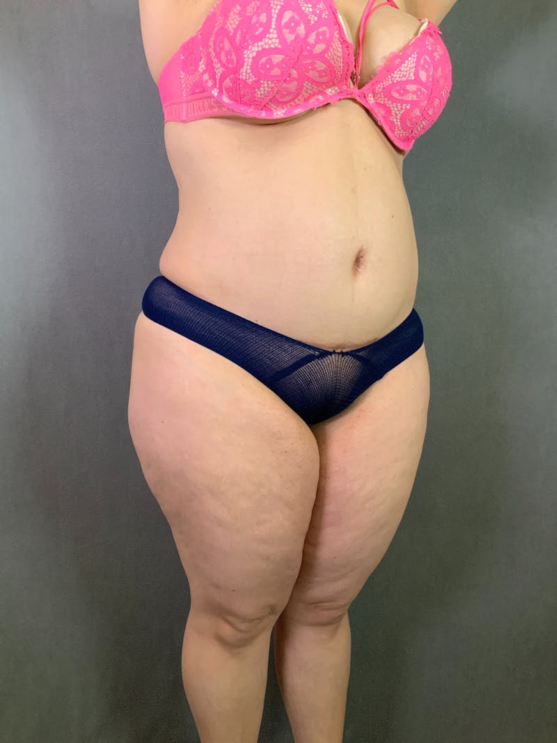 Liposuction Before & After Gallery - Patient 167391182 - Image 9