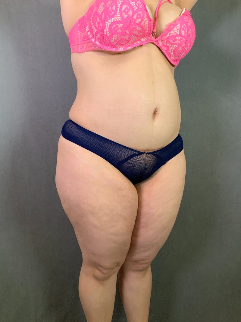 Liposuction Before & After Gallery - Patient 167391182 - Image 9