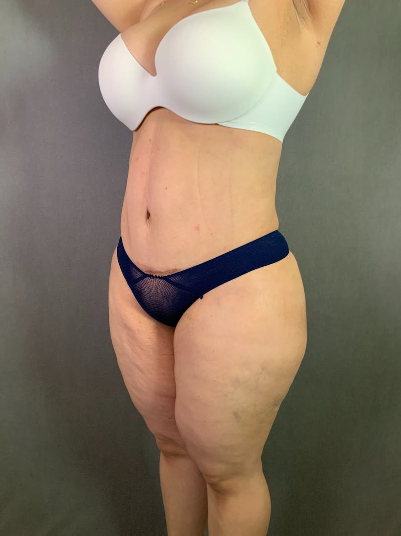 Liposuction Before & After Gallery - Patient 167391182 - Image 4