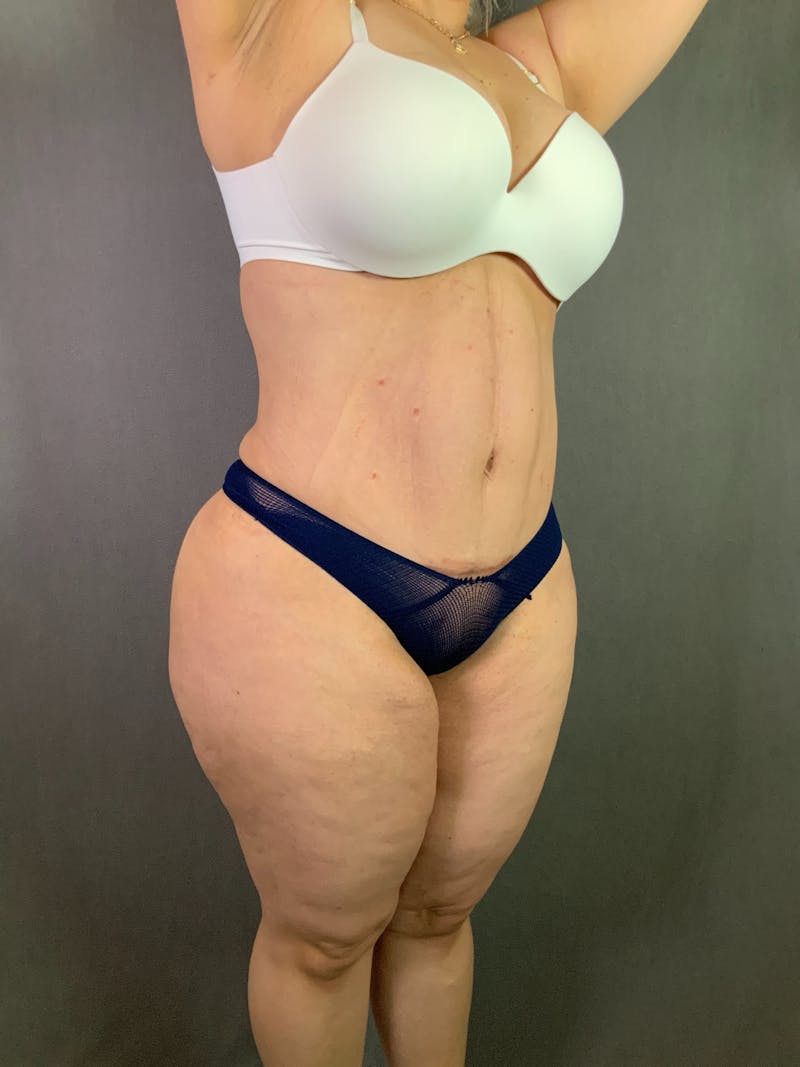 Liposuction Before & After Gallery - Patient 167391182 - Image 10