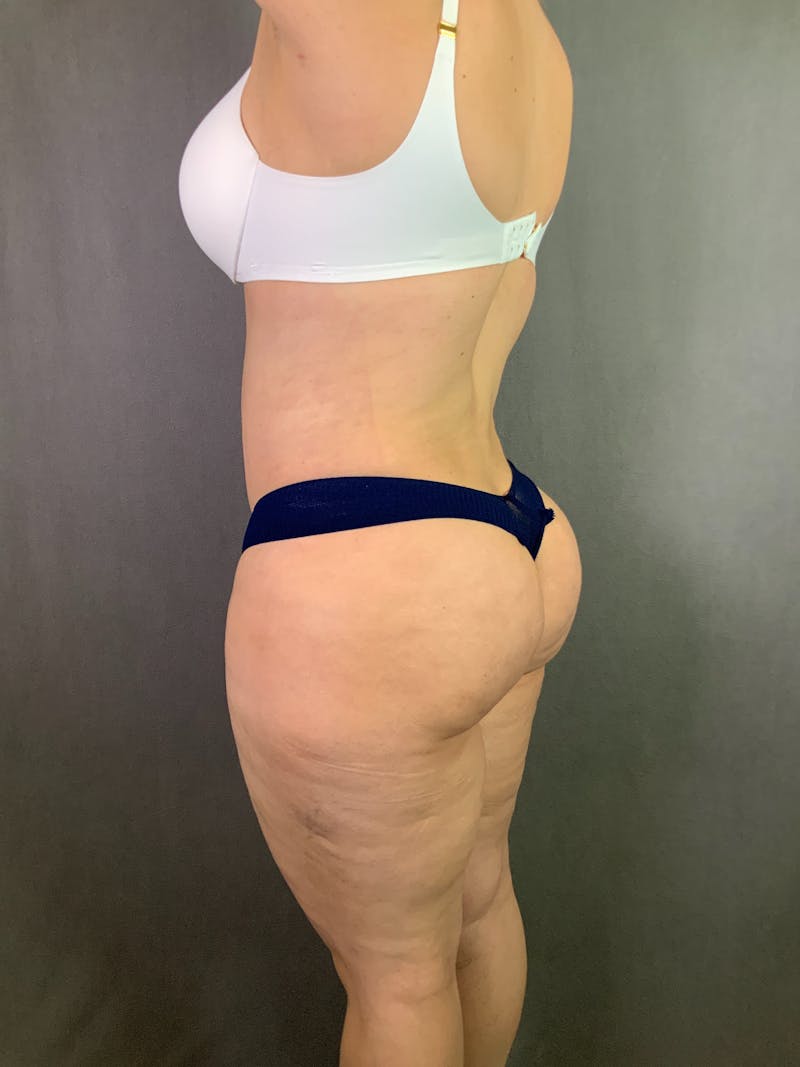 Liposuction Before & After Gallery - Patient 167391182 - Image 8
