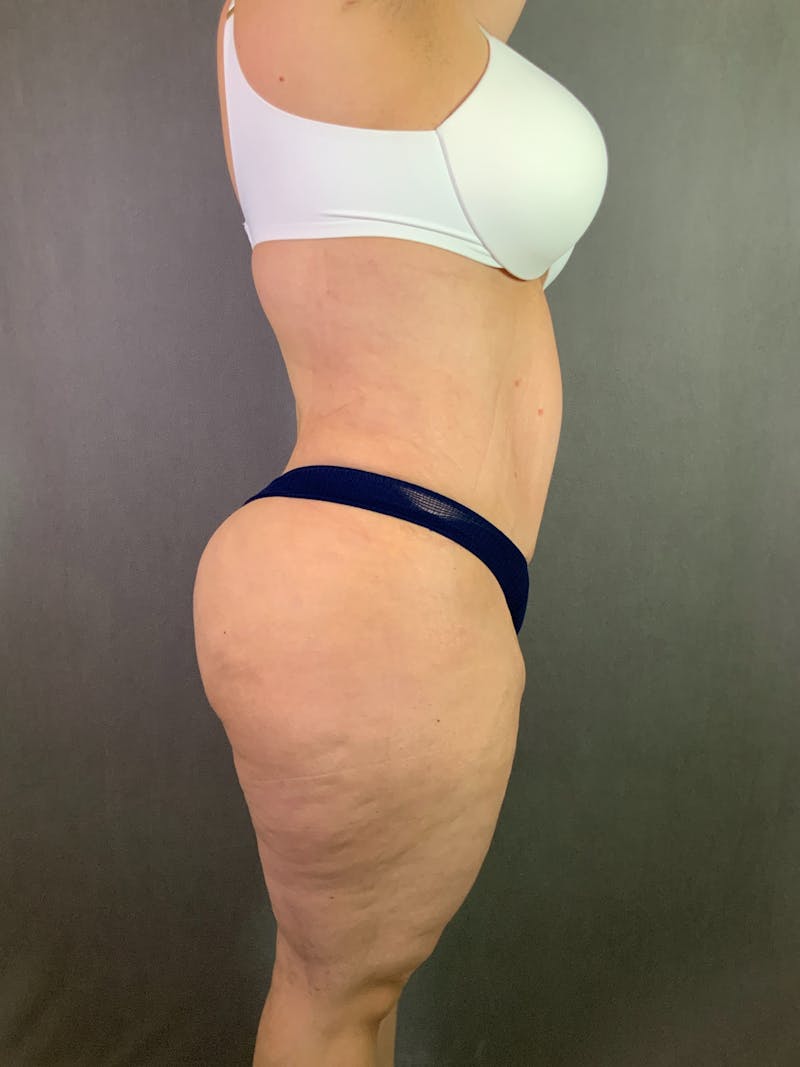 Liposuction Before & After Gallery - Patient 167391182 - Image 12