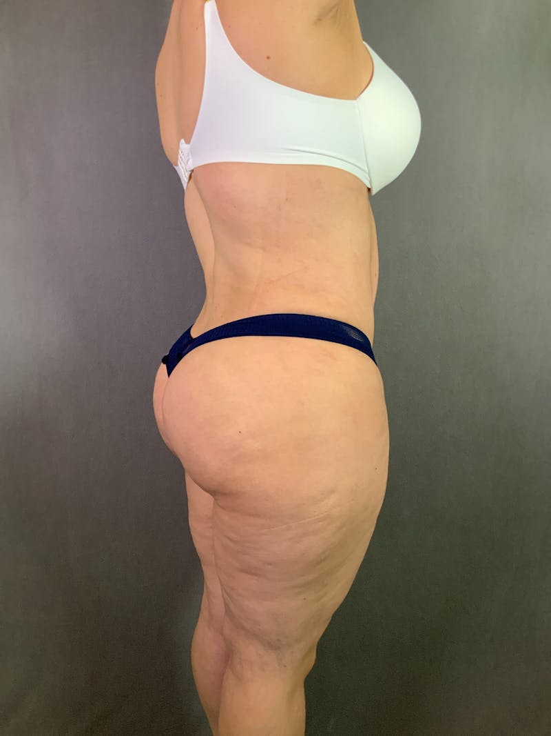 Liposuction Before & After Gallery - Patient 167391182 - Image 14