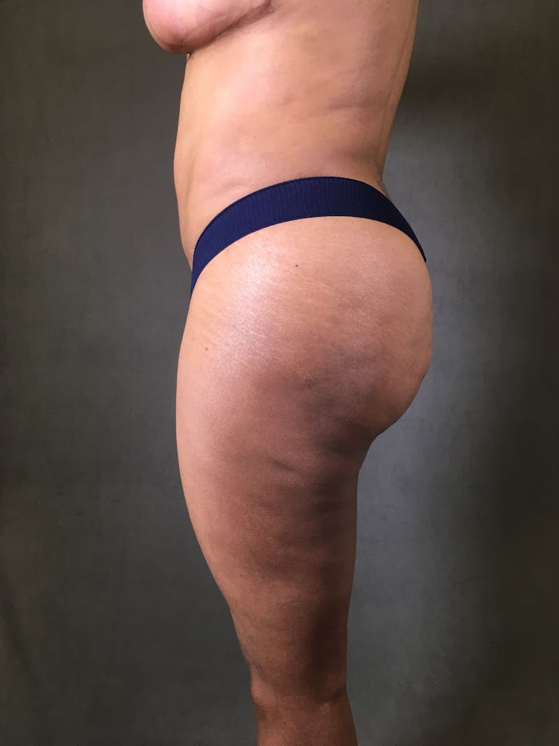 Liposuction Before & After Gallery - Patient 167391204 - Image 4