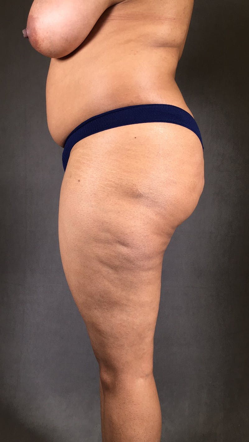 Liposuction Before & After Gallery - Patient 167391204 - Image 3