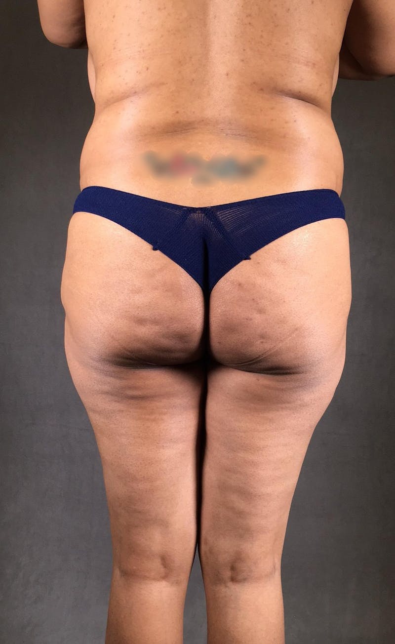 Liposuction Before & After Gallery - Patient 167391204 - Image 1