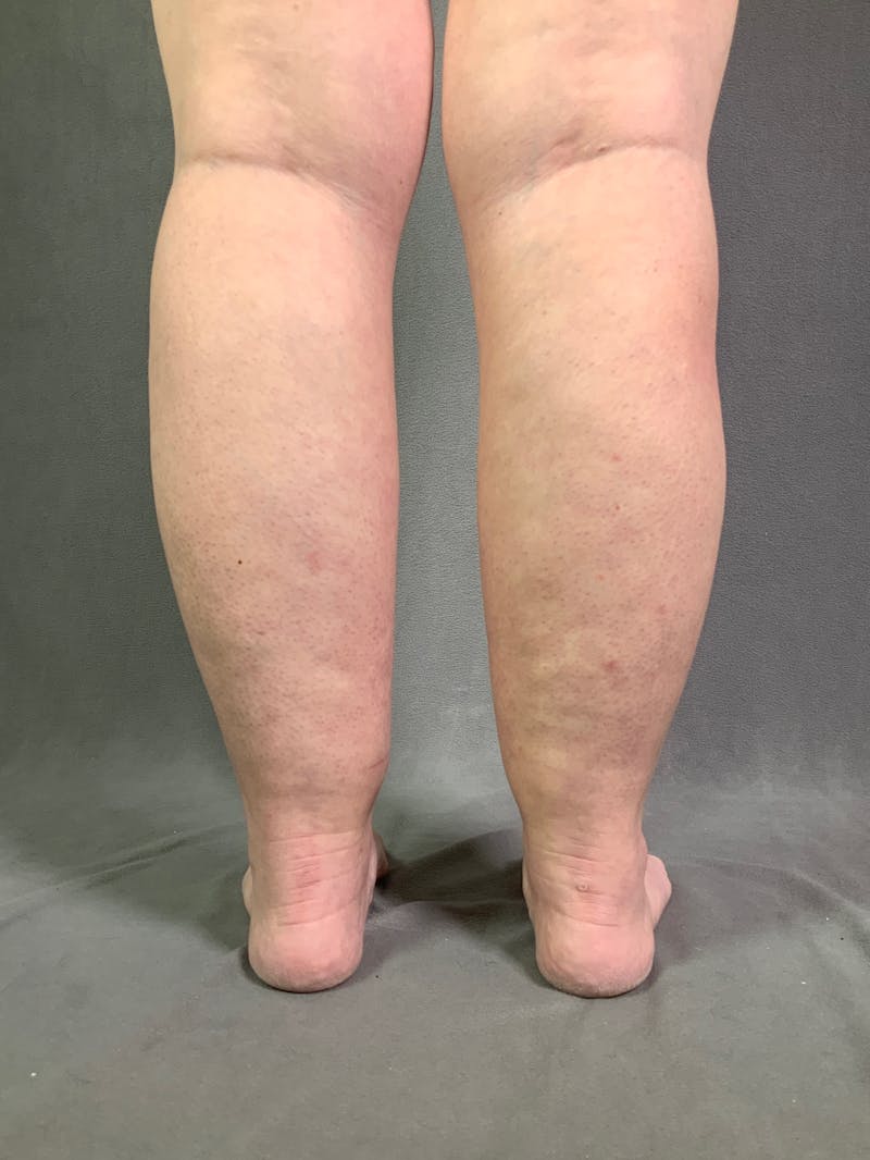 Liposuction Before & After Gallery - Patient 167391243 - Image 13