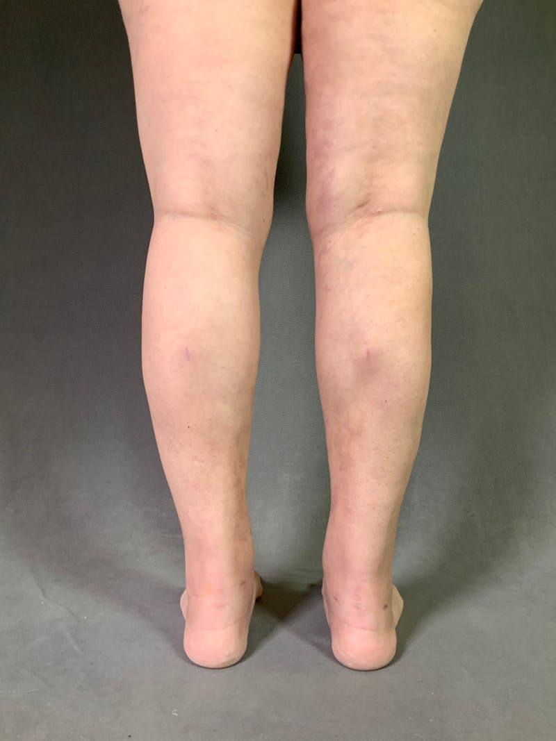 Liposuction Before & After Gallery - Patient 167391243 - Image 14