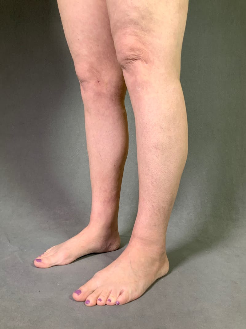 Liposuction Before & After Gallery - Patient 167391243 - Image 10