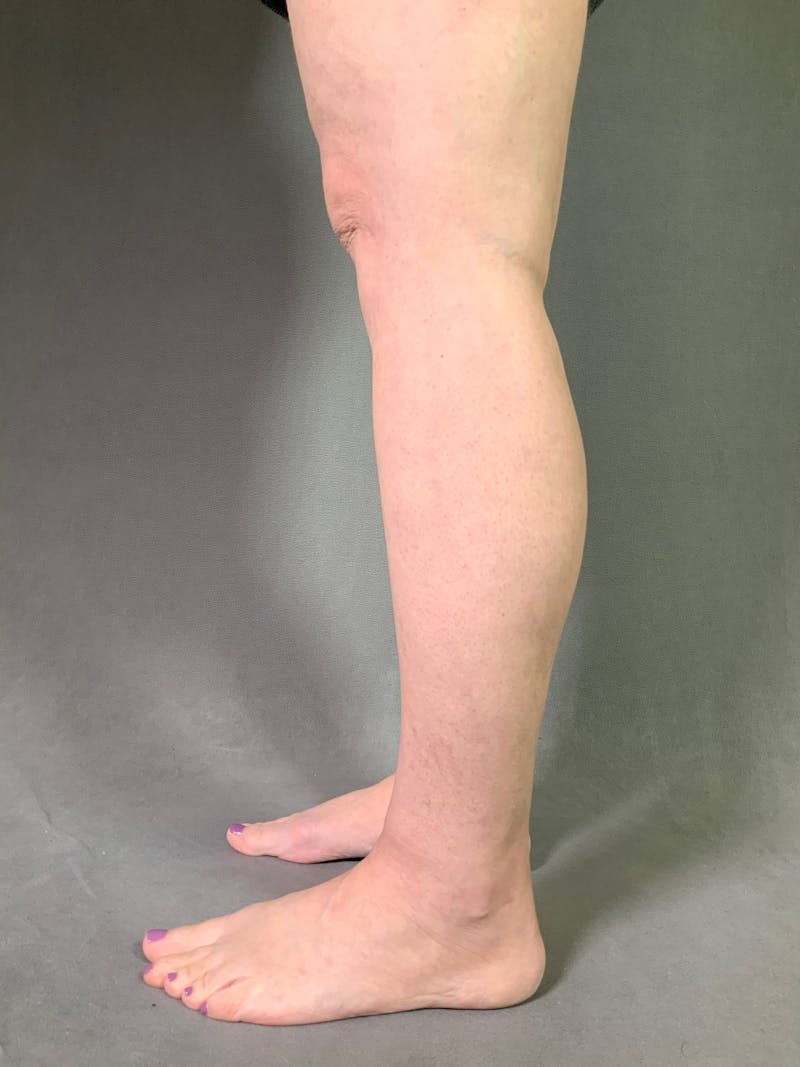 Liposuction Before & After Gallery - Patient 167391243 - Image 8