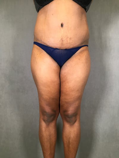 Liposuction Before & After Gallery - Patient 167391313 - Image 1