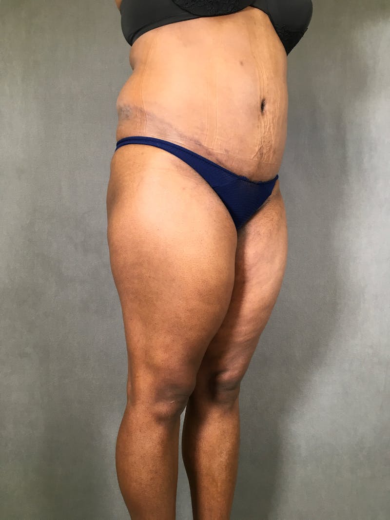 Liposuction Before & After Gallery - Patient 167391313 - Image 11