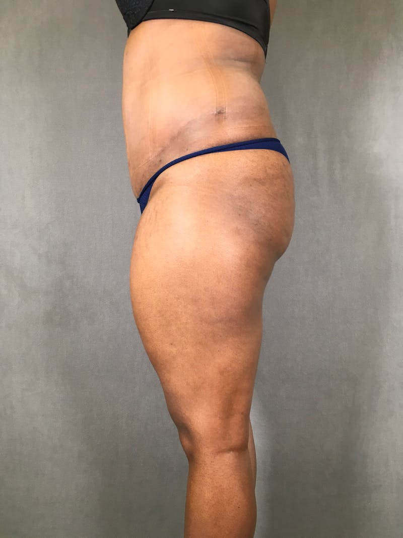 Liposuction Before & After Gallery - Patient 167391313 - Image 5