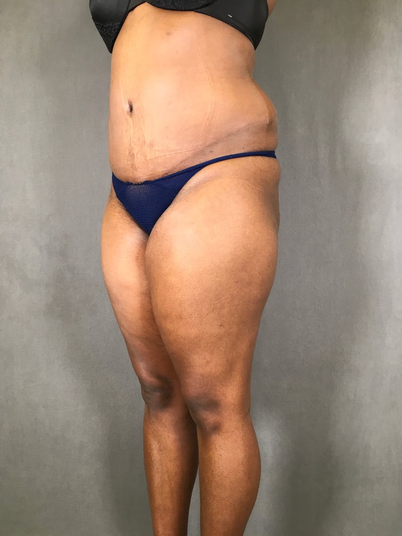 Liposuction Before & After Gallery - Patient 167391313 - Image 3