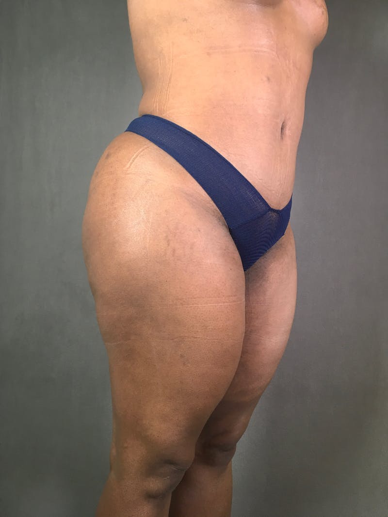 Liposuction Before & After Gallery - Patient 167391313 - Image 12