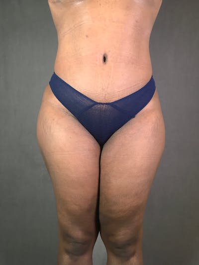 Liposuction Before & After Gallery - Patient 167391313 - Image 2