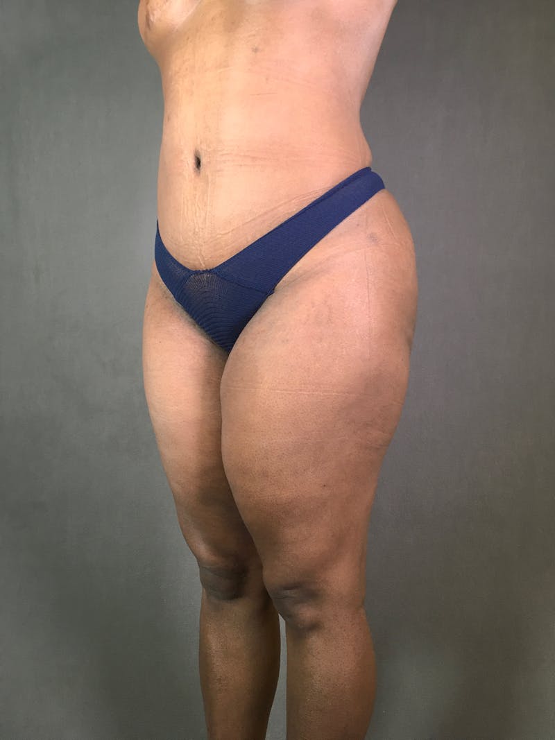 Liposuction Before & After Gallery - Patient 167391313 - Image 4