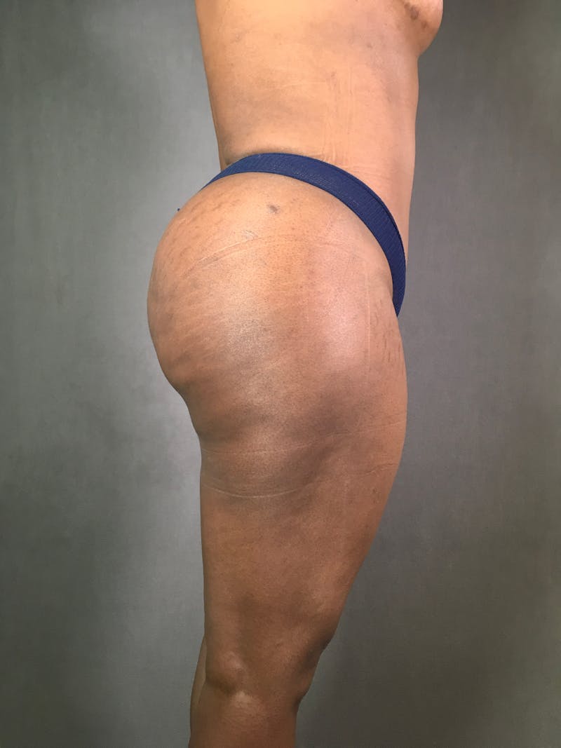 Liposuction Before & After Gallery - Patient 167391313 - Image 14