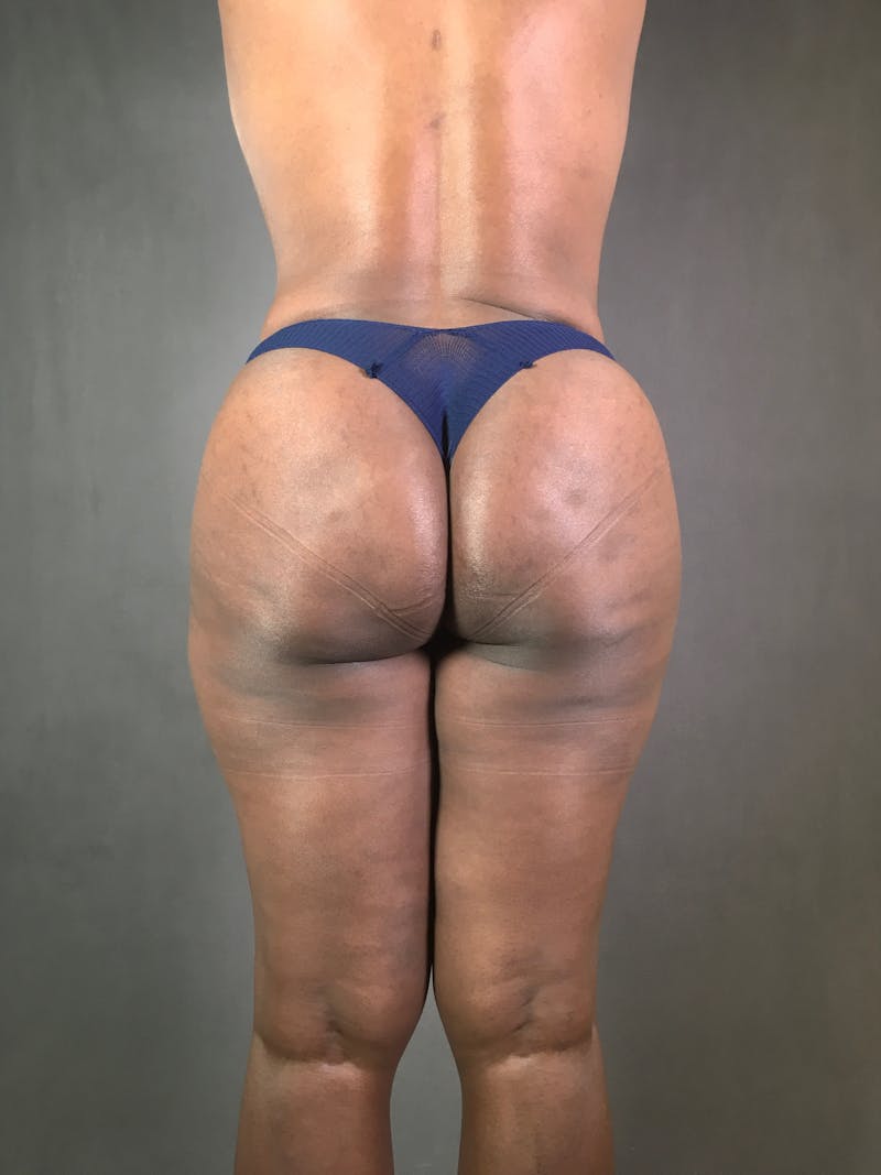Liposuction Before & After Gallery - Patient 167391313 - Image 10