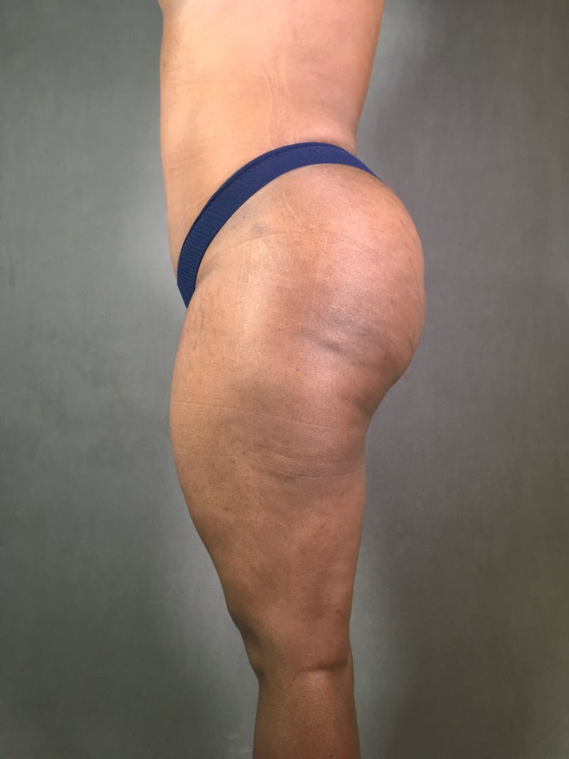 Liposuction Before & After Gallery - Patient 167391313 - Image 6