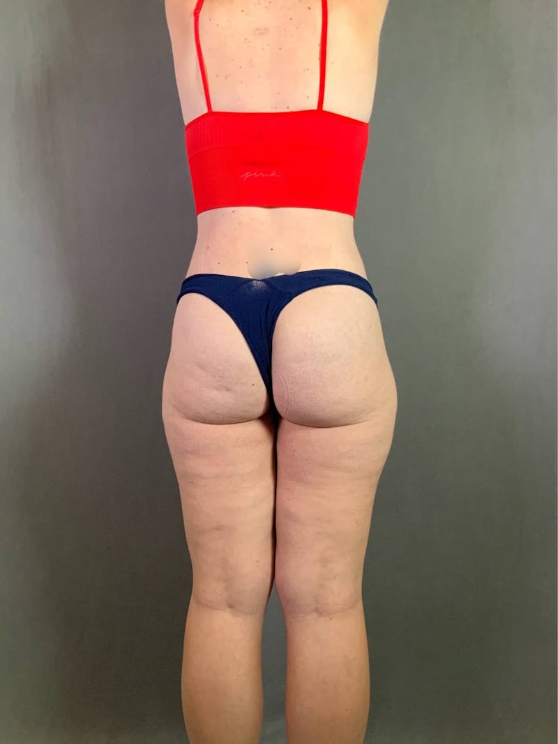 Extended Tummy Tuck  Before & After Gallery - Patient 167402490 - Image 8