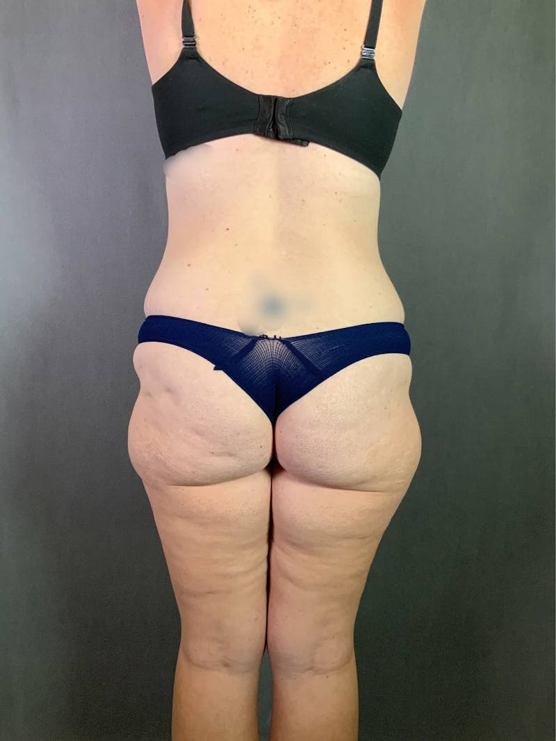 Extended Tummy Tuck  Before & After Gallery - Patient 167402490 - Image 7