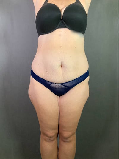 Extended Tummy Tuck  Before & After Gallery - Patient 167402490 - Image 1