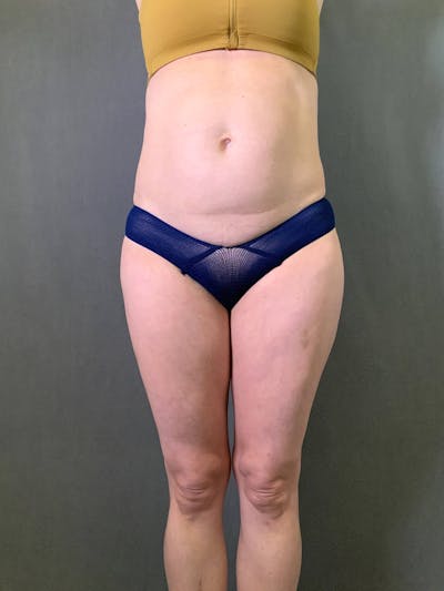 Mini-Tummy Tuck Before & After Gallery - Patient 167403164 - Image 1