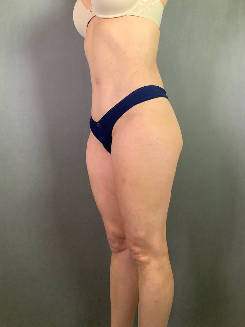 Mini-Tummy Tuck Before & After Gallery - Patient 167403164 - Image 4