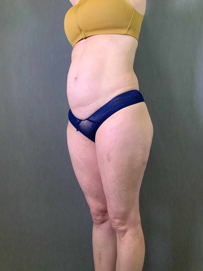 Mini-Tummy Tuck Before & After Gallery - Patient 167403164 - Image 3