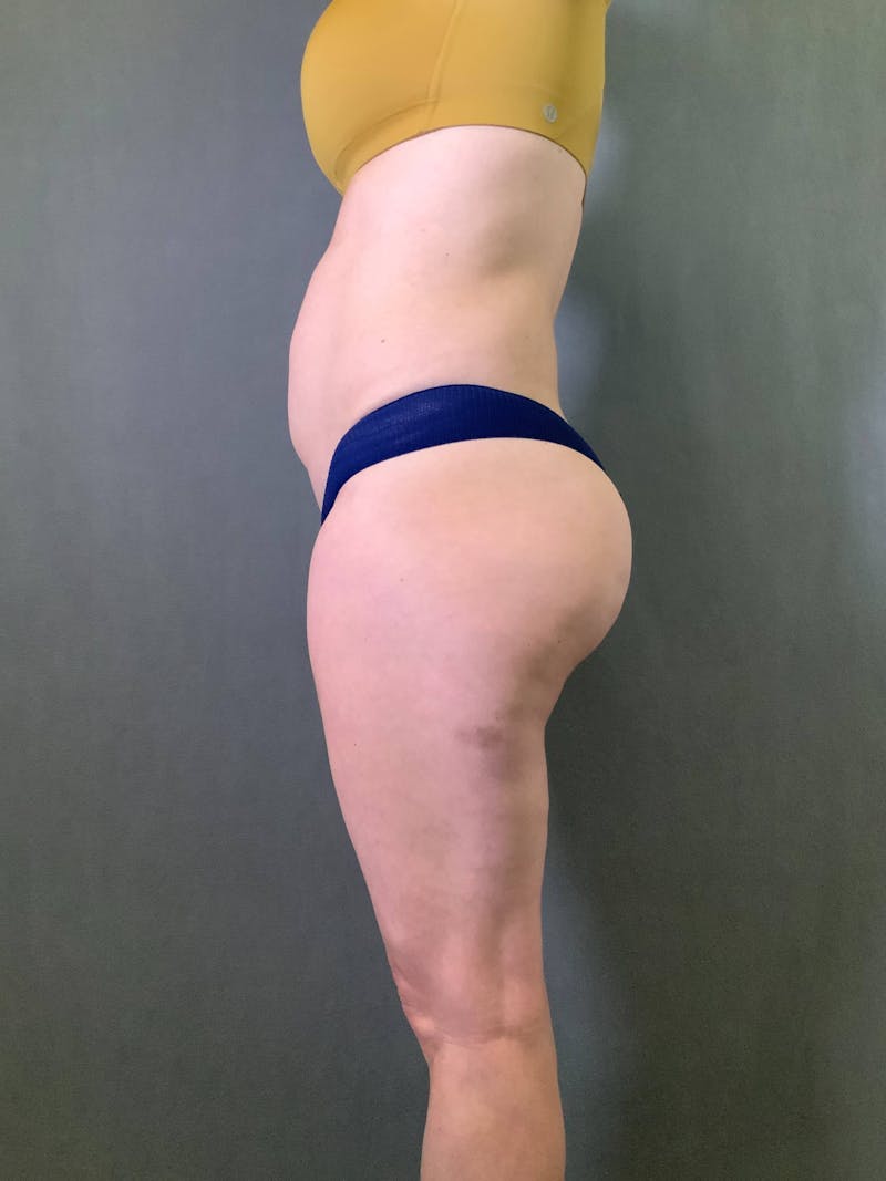 Mini-Tummy Tuck Before & After Gallery - Patient 167403164 - Image 5
