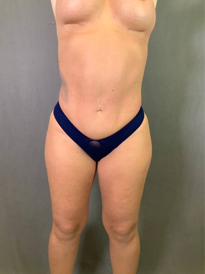 Mini-Tummy Tuck Before & After Gallery - Patient 167403165 - Image 2