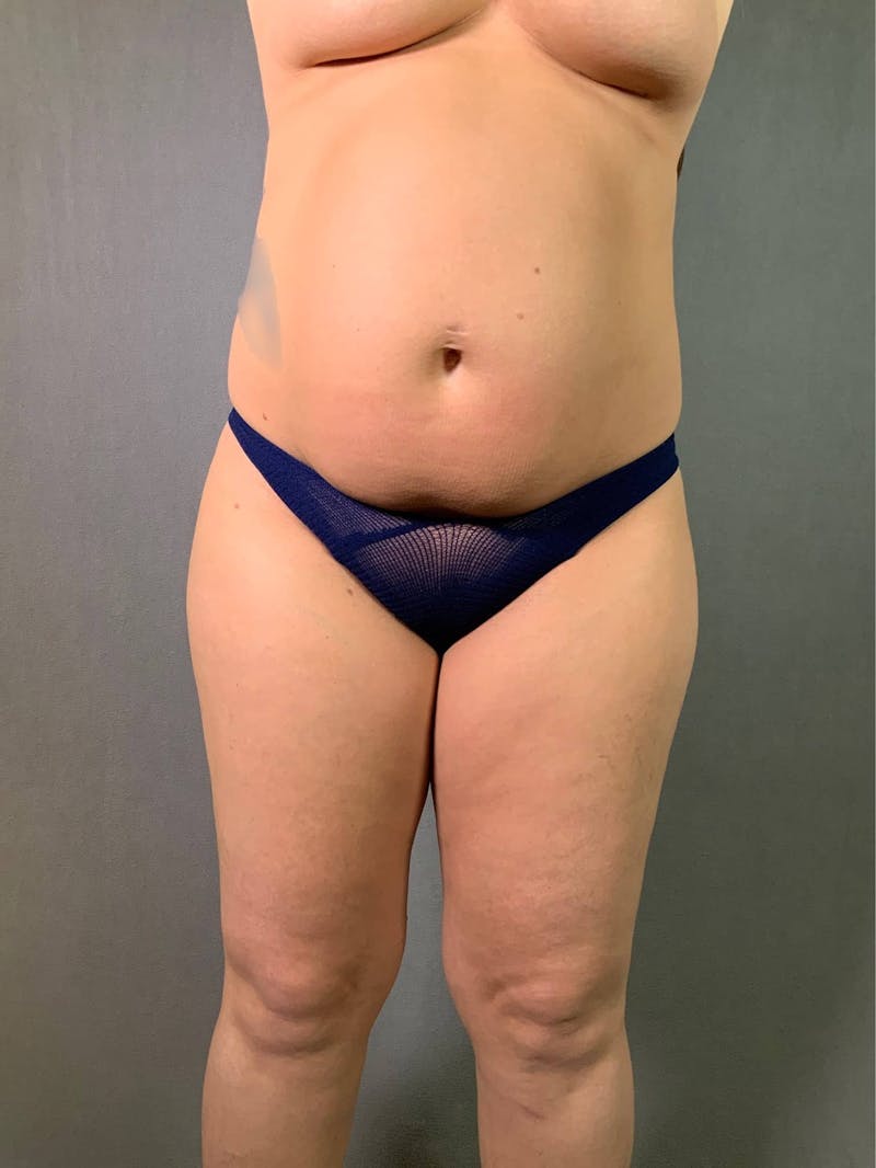 Mini-Tummy Tuck Before & After Gallery - Patient 167403165 - Image 1