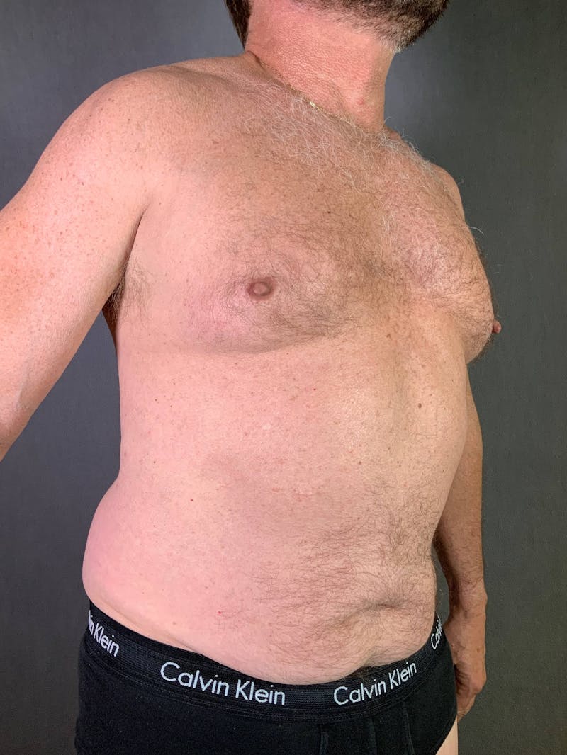 Mini-Tummy Tuck Before & After Gallery - Patient 167403166 - Image 3