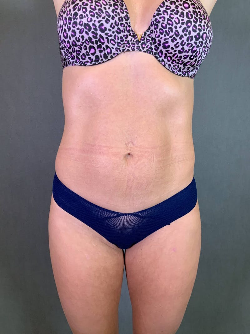 Mini-Tummy Tuck Before & After Gallery - Patient 167403167 - Image 1