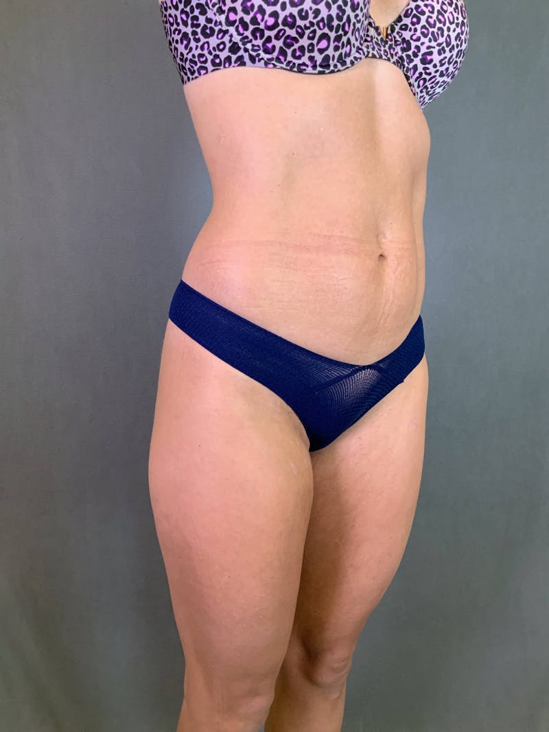 Mini-Tummy Tuck Before & After Gallery - Patient 167403167 - Image 3