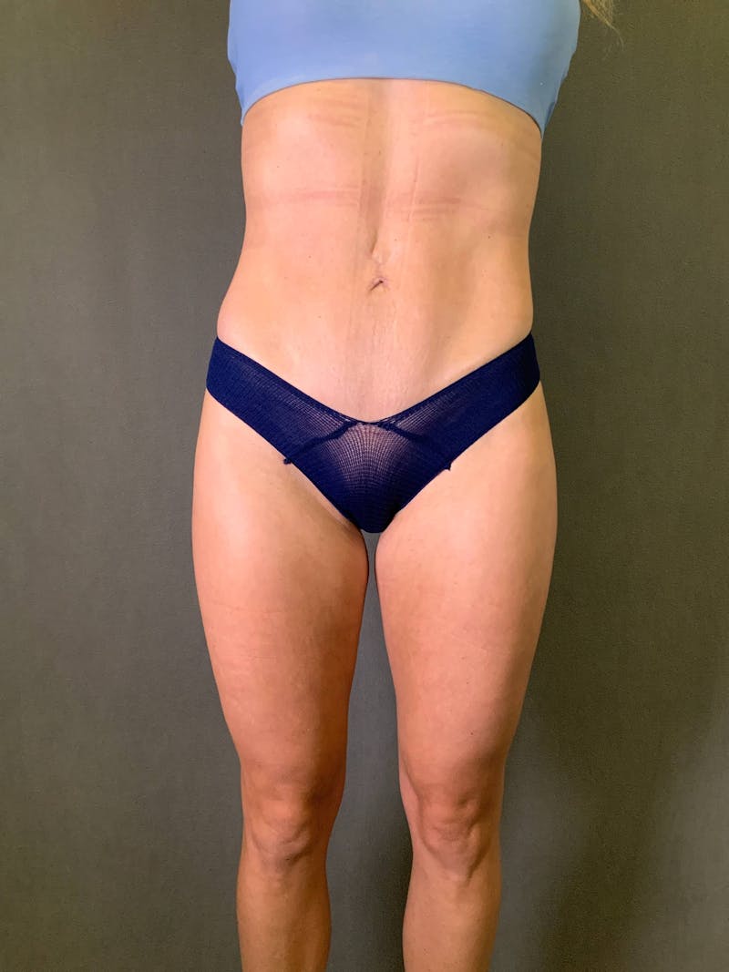 Mini-Tummy Tuck Before & After Gallery - Patient 167403167 - Image 2