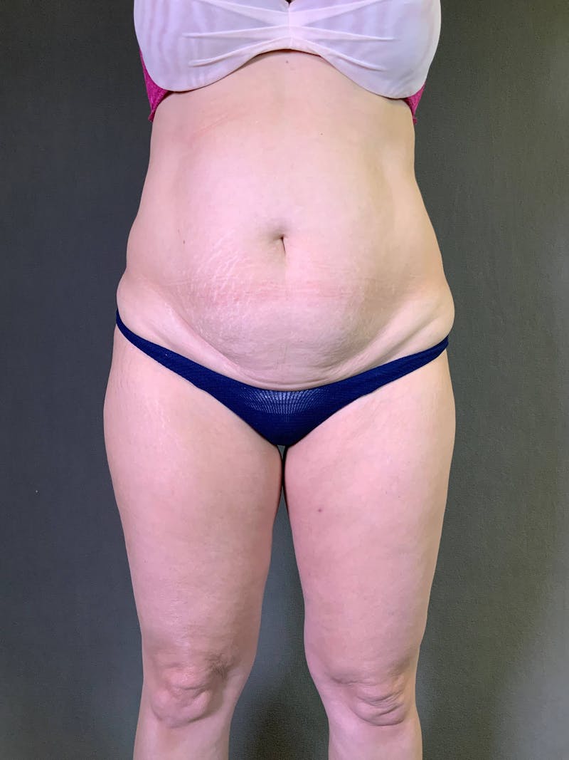 Mini-Tummy Tuck Before & After Gallery - Patient 167403168 - Image 1