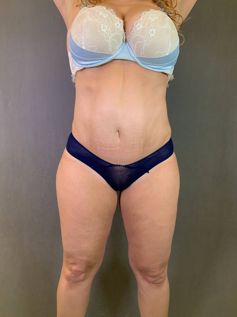 Mini-Tummy Tuck Before & After Gallery - Patient 167403168 - Image 2