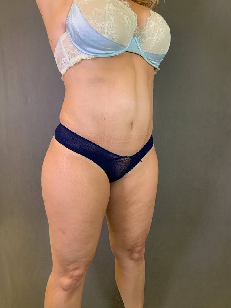Mini-Tummy Tuck Before & After Gallery - Patient 167403168 - Image 4