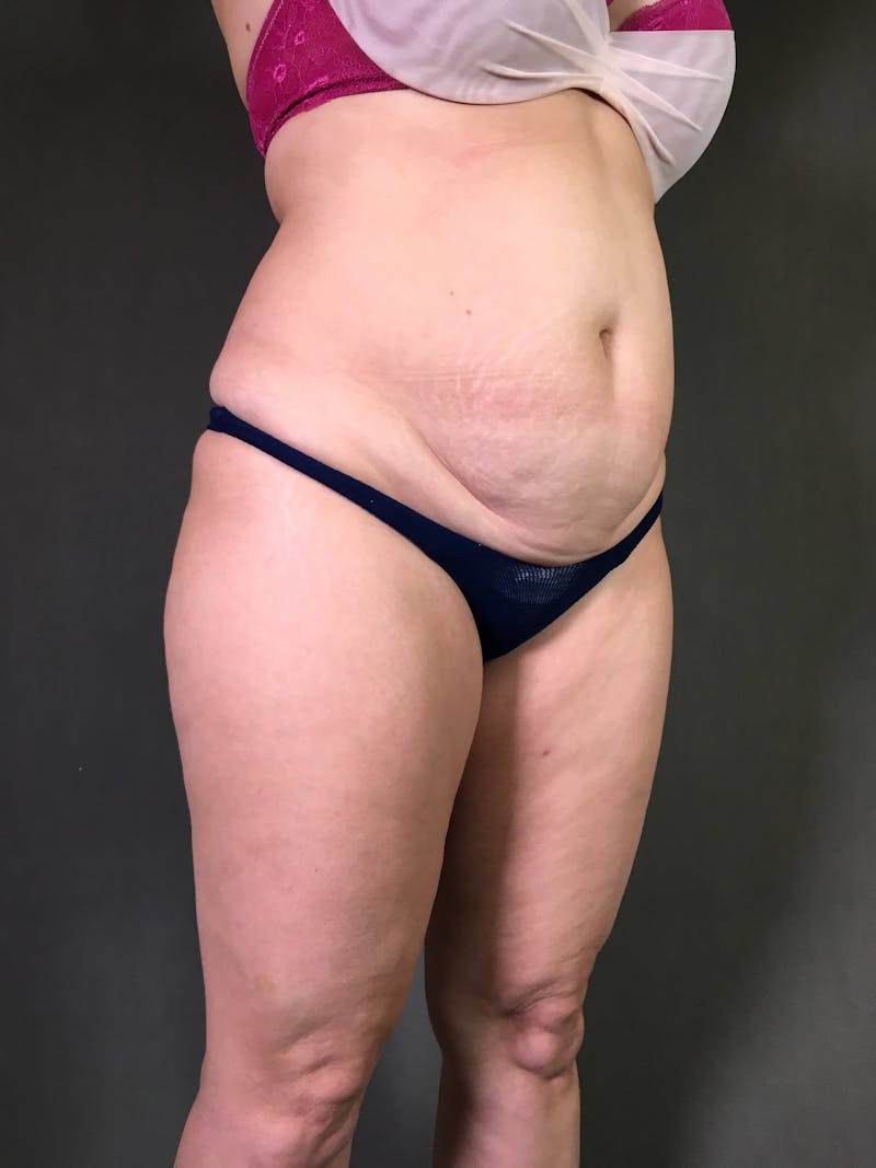 Mini-Tummy Tuck Before & After Gallery - Patient 167403168 - Image 3