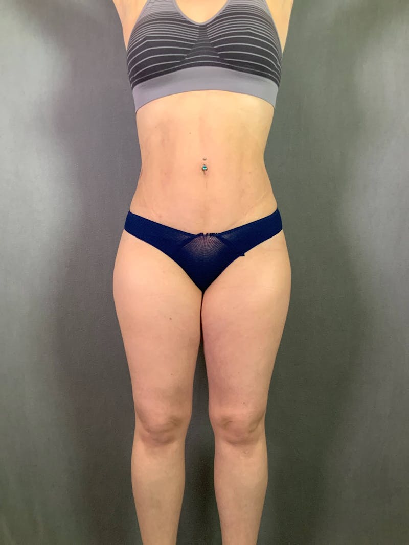 Mini-Tummy Tuck Before & After Gallery - Patient 167403169 - Image 2