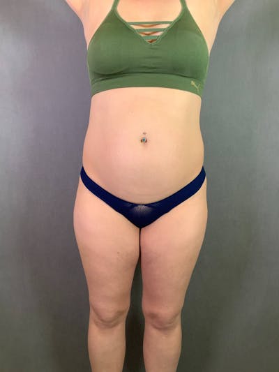 Mini-Tummy Tuck Before & After Gallery - Patient 167403169 - Image 1