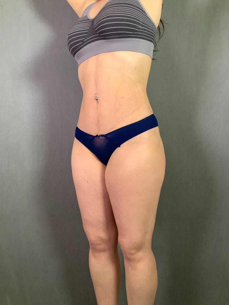 Mini-Tummy Tuck Before & After Gallery - Patient 167403169 - Image 4