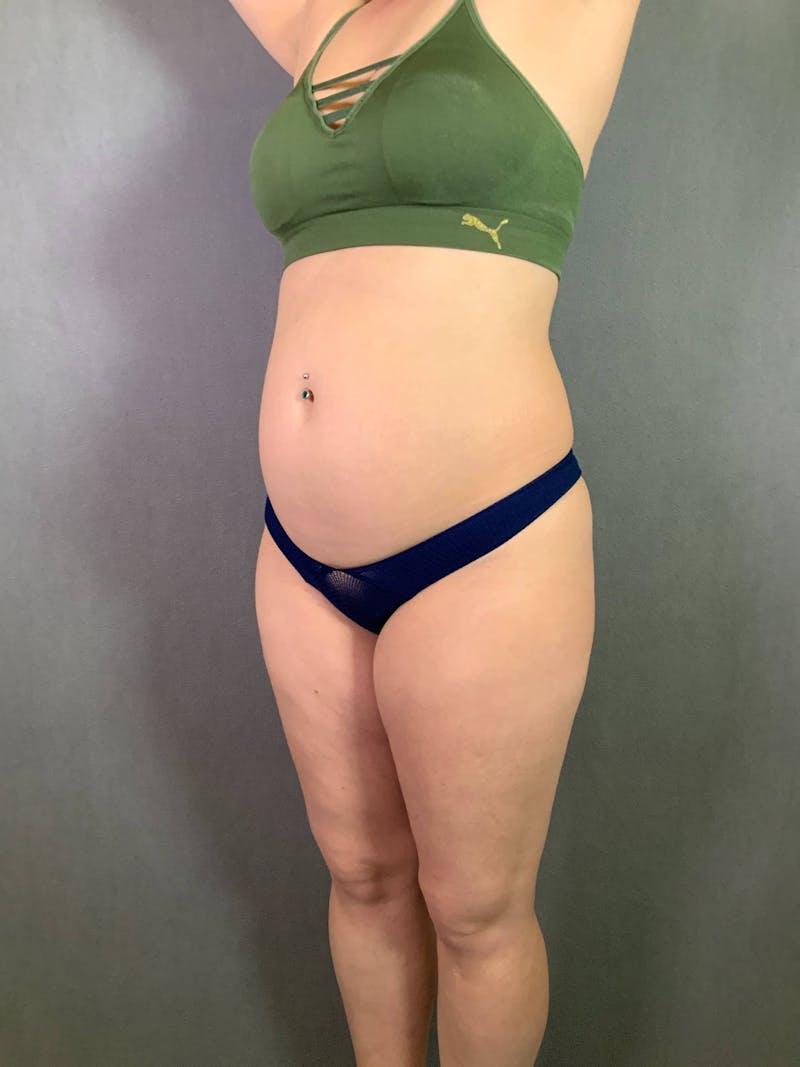 Mini-Tummy Tuck Before & After Gallery - Patient 167403169 - Image 3