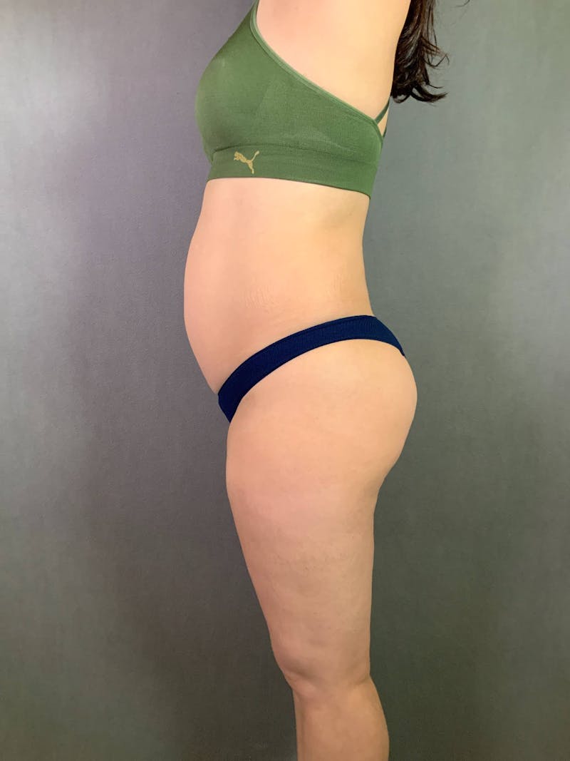 Mini-Tummy Tuck Before & After Gallery - Patient 167403169 - Image 5