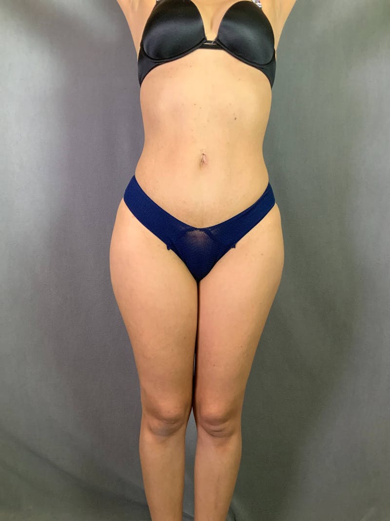 Mini-Tummy Tuck Before & After Gallery - Patient 167403179 - Image 2