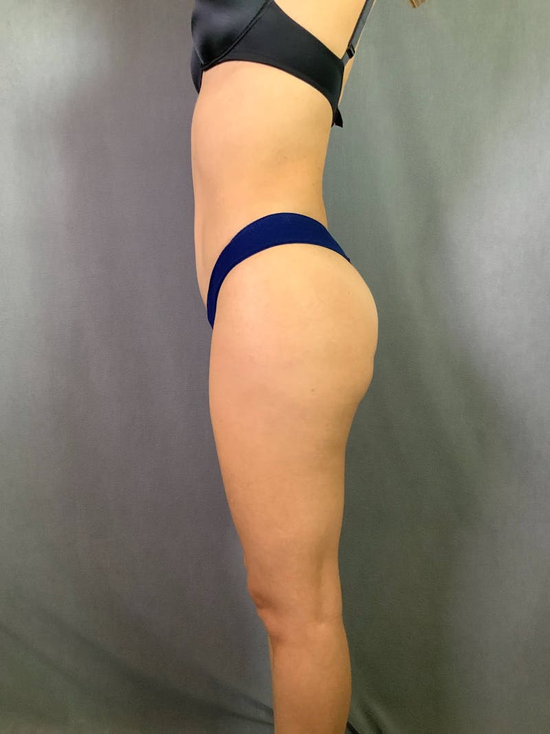 Mini-Tummy Tuck Before & After Gallery - Patient 167403179 - Image 4
